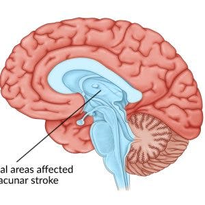 medical illustration of brain with center of the brain highlighted to identify lacunar stroke or lacunar infarct