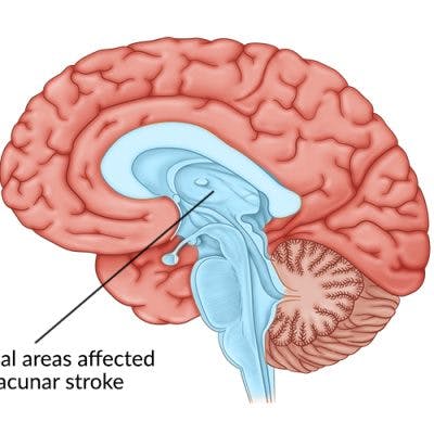 Pontine Stroke: Understanding the Effects & Recovery Process