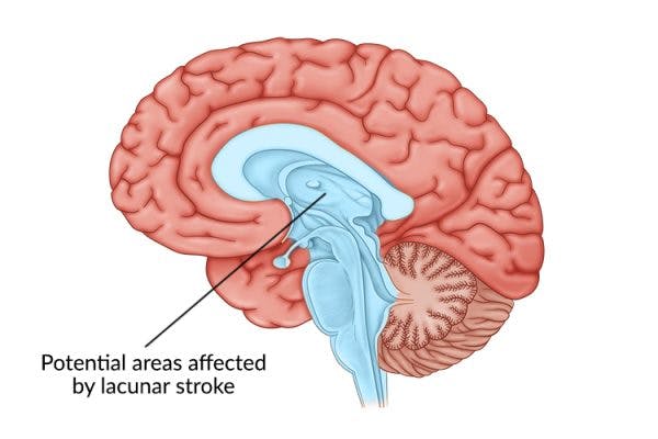 medical illustration of brain with center of the brain highlighted to identify lacunar stroke or lacunar infarct