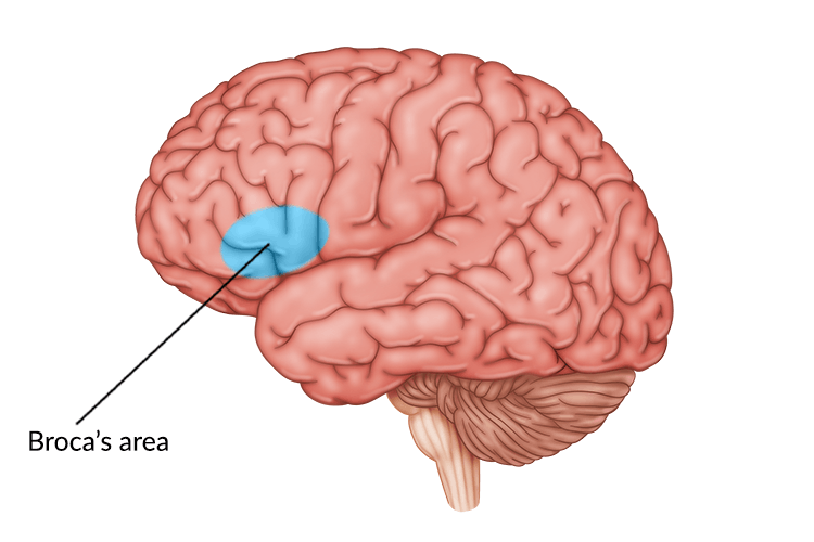 Illustration of damage to Broca's area after traumatic brain injury.