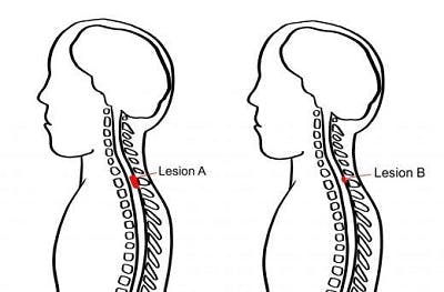 illustration of lesions to help determine incomplete spinal cord injury recovery time